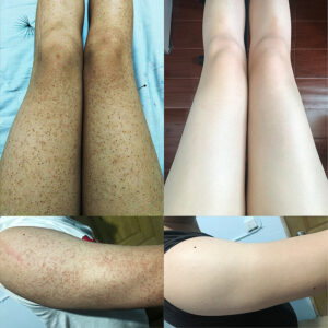 Pele de galinha não esfoliante periqueratinizada ácido salicílico não esfoliante soro de coxa de leite corporal pele de escamas de peixe