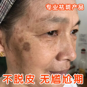 O líquido para remoção de sardas decompõe a melanina, não se descasca sem embaraço, sardas de salão de beleza, melasma, sérum clareador